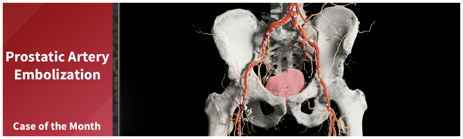 bpc 157 and enlarged prostate Case of the Month – Embolization – 3D Quantitative Imaging Laboratory In stock Size:10mg Nasal Spray Methylcobalamin B12 Injection -